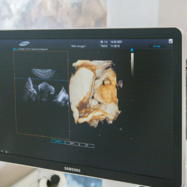 3D/4D ultrazvukový přístroj