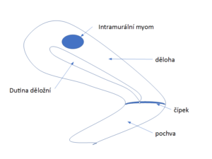 Myomy nacházející se ve stěně dělohy (intramurální myom)