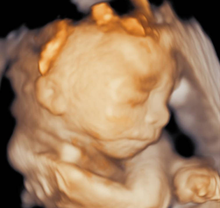 Těhotenský screening