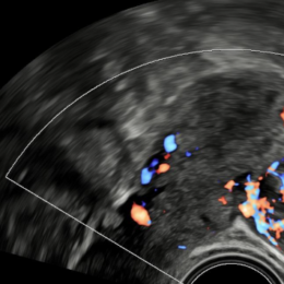 Myom dělohy rostoucí do dutiny břišní.